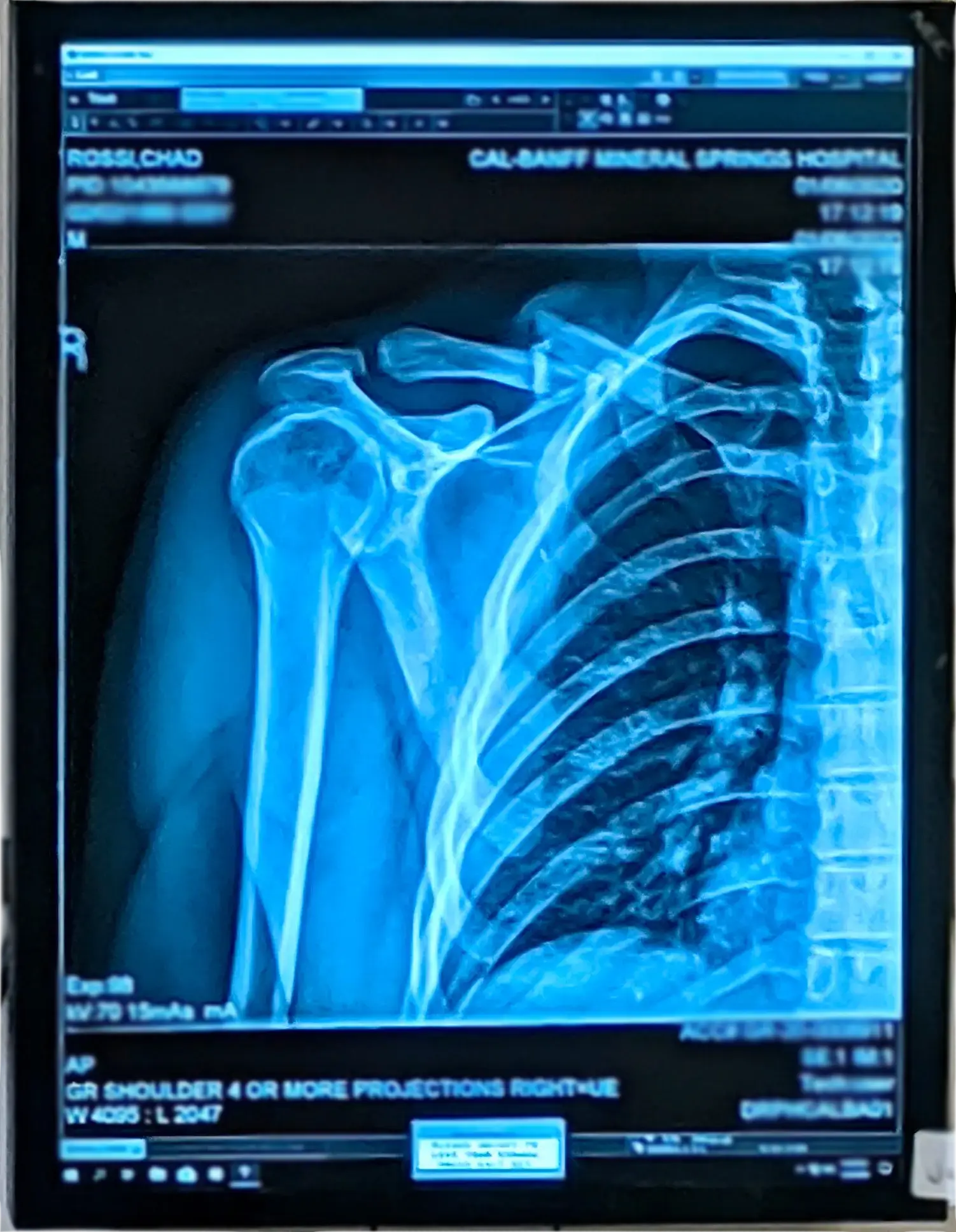 X-ray of founder Chad's broken collarbone, a snowboarding battle scar